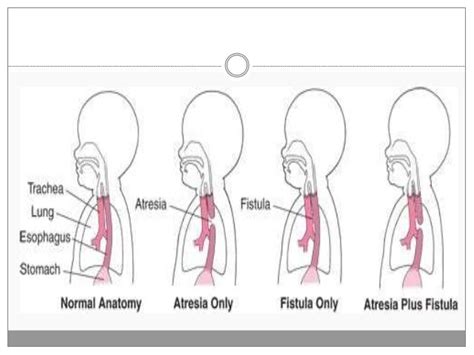 Tracheoesophageal Fistula Tef – Dr Trynaadh