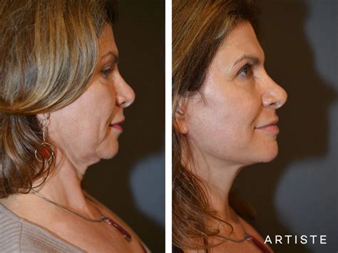 Deep Plane Facelift Before And After Artiste Plastic Surgery