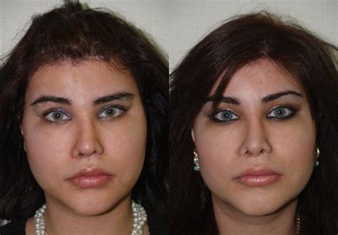 Transgender Surgery Before And After Pictures Facial