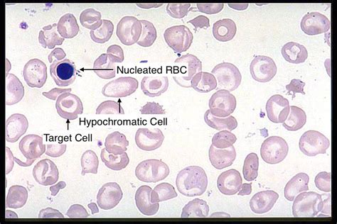 thalassemia stepwards