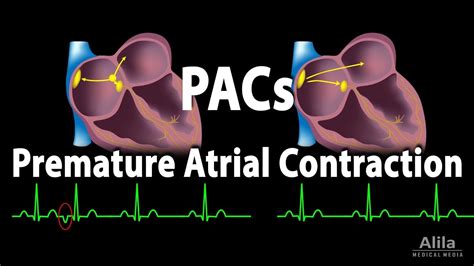 premature atrial contractions pacs animation youtube