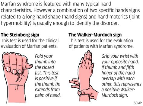 lifelong drug therapy  key  coping  marfan syndrome south