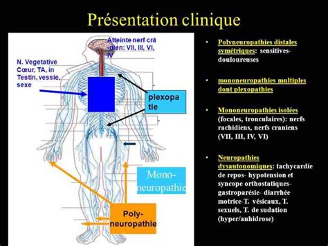 La Définition Des Neuropathies Douloureuses