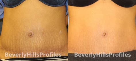 Stretch Mark Removal Before And After Photos Los Angeles