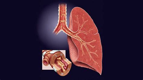chronic bronchitis and copd everyday health