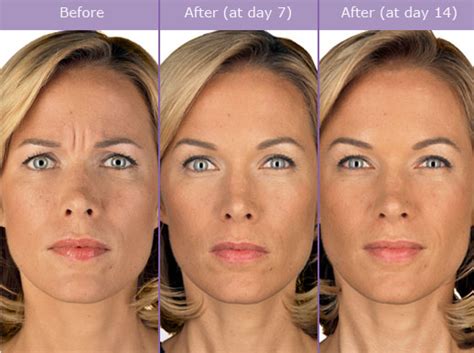 botox before and after photos miami beach south beach