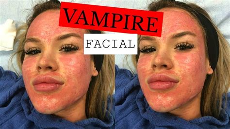 vampire facial  footage dailypolina youtube