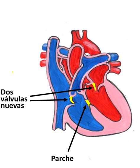 defecto del canal atrioventricular cardiosaudeferrol