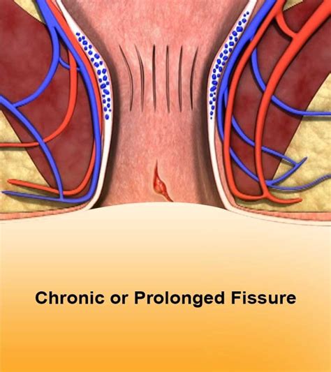 anal fissure surgery what are the symptoms causes and