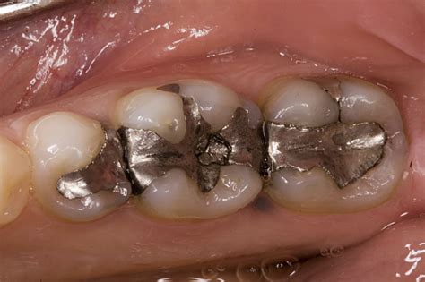 mercury  dental fillings biological dentistry