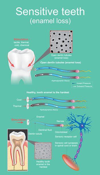 sensitive teeth sensitive teeth  treatment tooth sensitivity