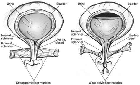 Bladder Control Problems In Women Urinary Incontinence