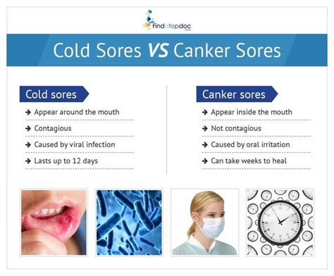 What Are Canker Sores