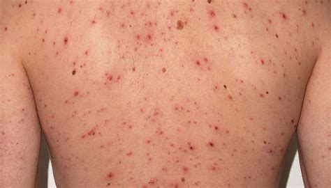 Chickenpox In Adults Symptoms Treatments And Vaccination