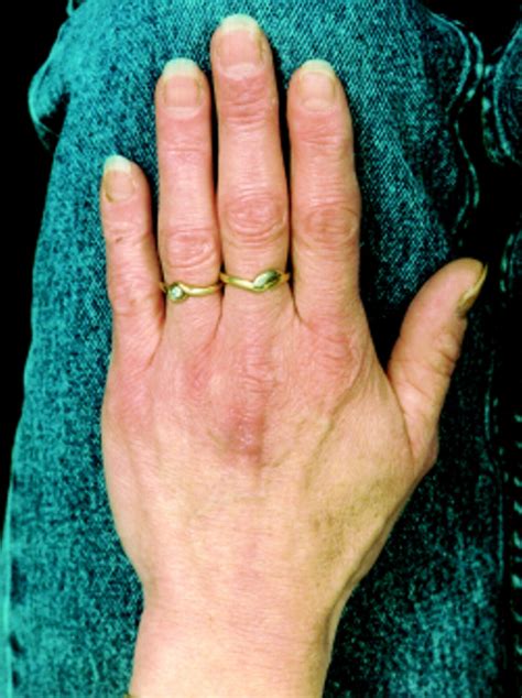 unusual  memorable  tender swelling   dorsum   hand