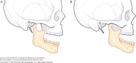 chapter 183 temporomandibular joint dislocation reduction