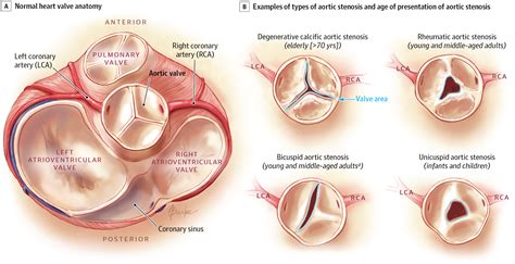 Asymptomatic Aortic Stenosis In The Elderly Valvular Heart Disease