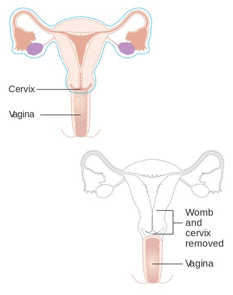 hysterectomy wikipedia