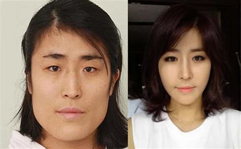 korean woman gets new face and a fiancé thanks to amazing plastic surgery opposing views