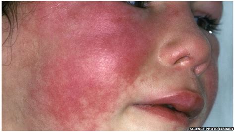 Scarlet Fever Highest Number Of Cases In 20 Years Bbc News