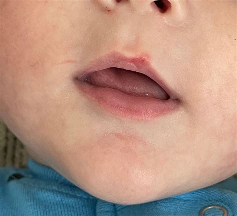 baby cold sore babycenter