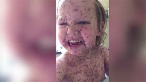 tot hospitalised with worst chickenpox docs had ever seen after