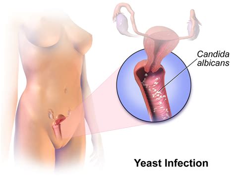 Difference Between Chlamydia And Yeast Infection