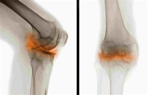 pictures  osteoarthritis locations symptoms diagnosis