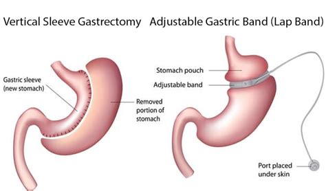 Gastric Sleeve Vs Lap Band® All You Need To Know