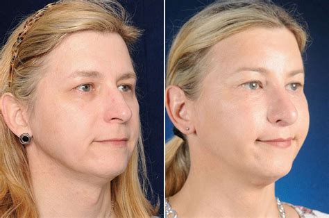 Facial Feminization Surgery Facelift Surgery Rejuvenating And