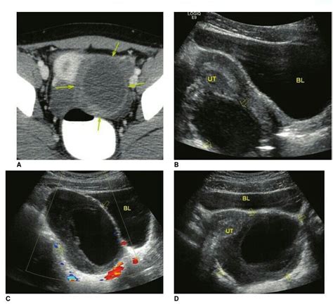 rt ovarian torsion      ultrasound sonography radiology