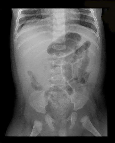 Abdominal X Ray Showing Small Bowel Obstruction
