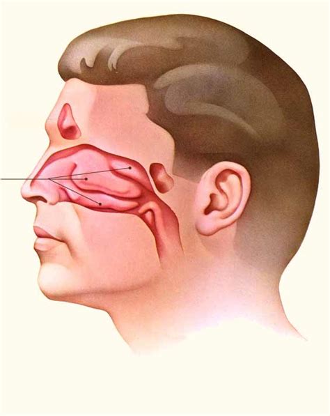 find    congested nose  due   deviated septum  enlarged turbinates
