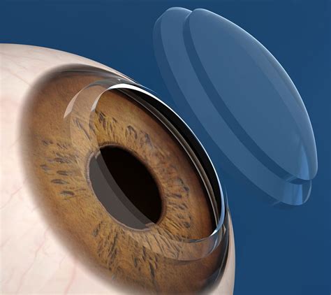 cornea transplant surgery  ecuador clinica sancho