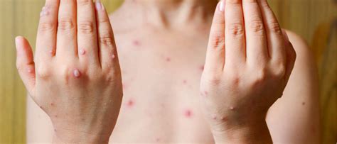 Everything You Need To Know About Chickenpox London Travel Clinic