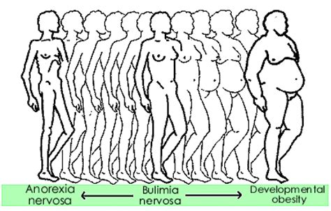 Sexual anorexia and conditions for binge purge