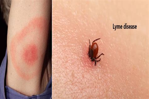 What Is Lyme Disease – Causes Symptoms Diagnoses And More