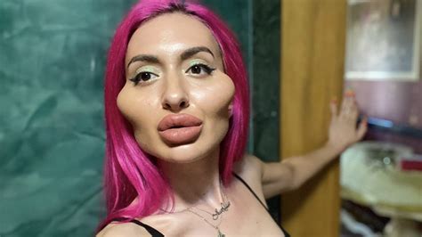 Die Frau Mit Den Größten Wangen Der Welt Will Mehr Botox