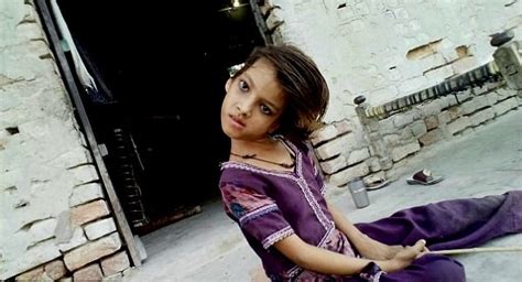 nine year old pakistani girl whose head hangs at 180 degree angle is