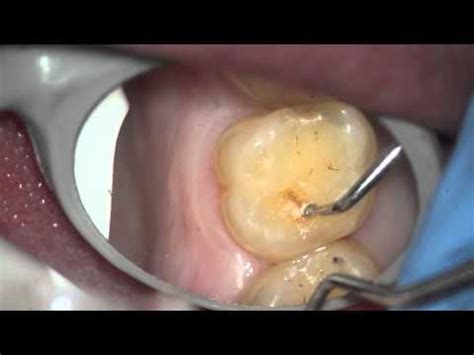 hole  tooth   filling    youtube