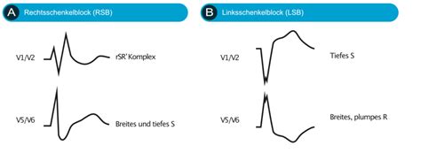 Linksschenkelblock Lsb Ekg Kriterien Ursachen Management – Ekg And Echo