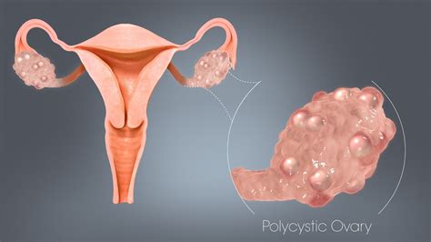 pcos theories   occurrence scientific animations