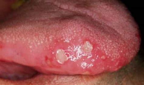 herpes on tongue pictures symptoms causes treatment