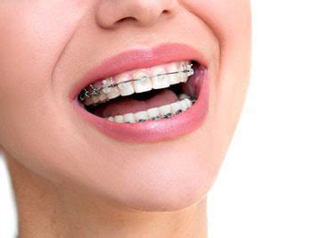 wear rubber bands   braces orthodontist
