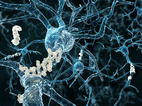 amyloid plaques  consequence    alzheimers disease