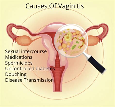 vaginitis types causes symptoms diagnosis and treatment