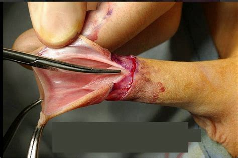 circumcised women female genital mutilation
