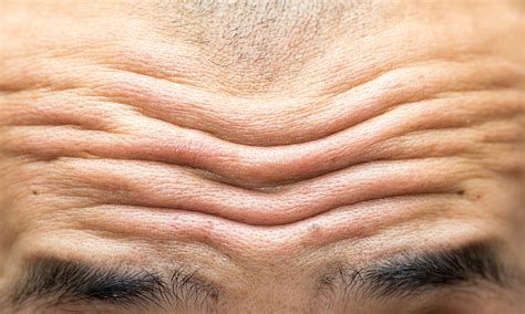 forehead wrinkles       rid forehead treatments
