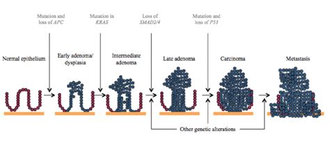 8 The Adenoma Carcinoma Sequence Of Colorectal Cancer Illustration By