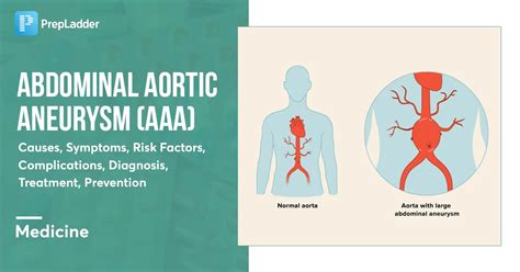 preventing abdominal aortic aneurysm complications   nurse expert